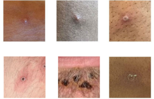 Monkeypox rash -- Photos: UK Health Security Agency, via CDC